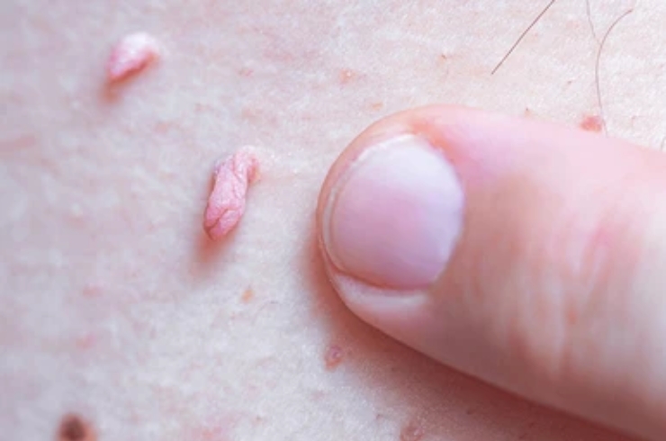 Genital Warts